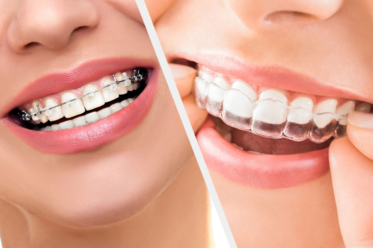 Transparent Braces - Invisible Aligners